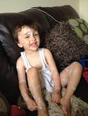 pox